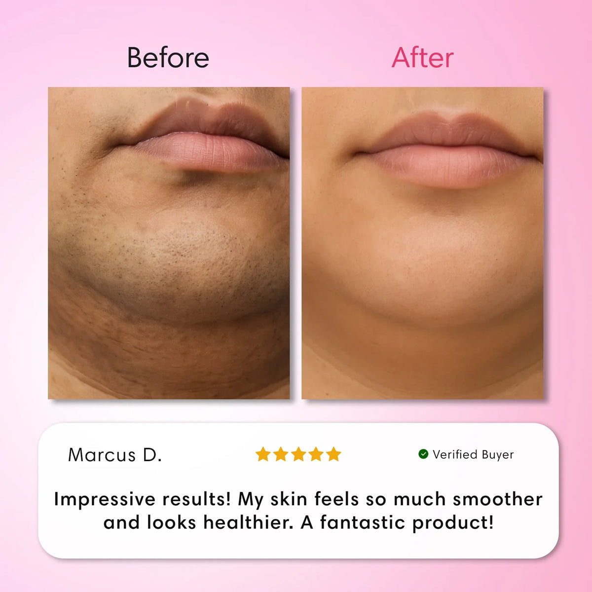 Cyperus™ Hair Removal Kit